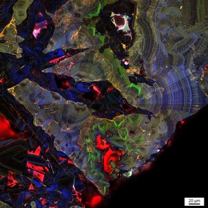 A fluorescence micrograph of a human kidney stone